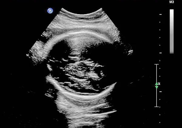 Ultrasound of fetus in third month pregnancy