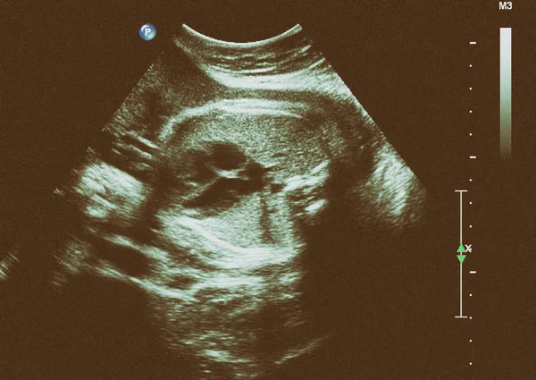 Ultraschall des Fötus in der Schwangerschaft im dritten Monat — Stockfoto