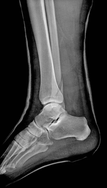 Ανθρώπινο Αριστερό Πόδι Πλευρική Όψη Ακτίνων — Φωτογραφία Αρχείου