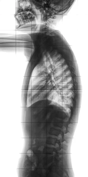 Vertikales Röntgen Der Menschlichen Wirbelsäule Und Des Kopfes — Stockfoto