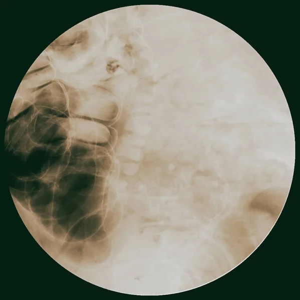 Barium Consula Image 검사를 큰창자나 결장의 해부학적 — 스톡 사진