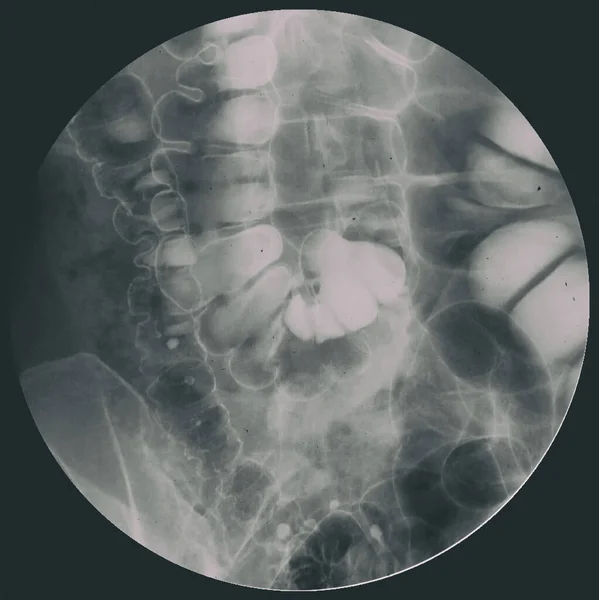 大腸がんを診断するための大腸または結腸の解剖学的構造を示す大腸X線画像または大腸X線図 — ストック写真
