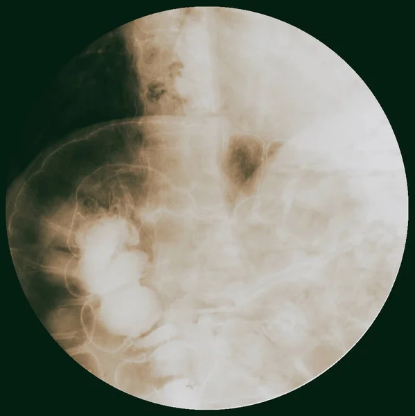 Röntgenundersökning Tjocktarmen Tjocktarmen Bariumlavemang Dubbelkontrastanalys — Stockfoto