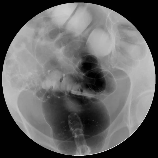 大腸がんを診断するための大腸または結腸の解剖学的構造を示す大腸X線画像または大腸X線図 — ストック写真