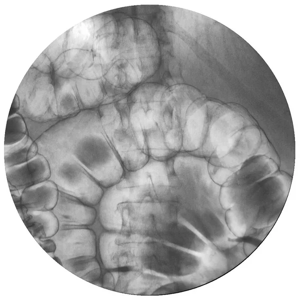 Röntgen Barium Lavemang Undersökning Nedre Gastrointestinala — Stockfoto