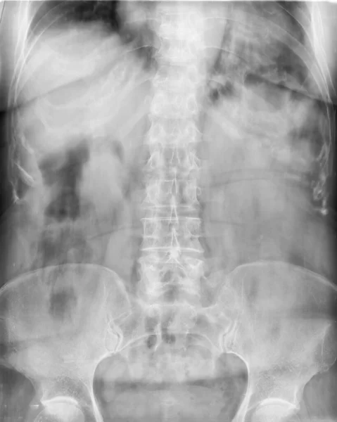 Röntgenstrålning Ländryggen Och Bäckenet Undersökning — Stockfoto