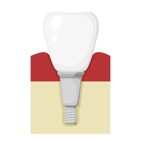 Ilustração química vetorial de um dente protético. Estanho dos desenhos animados —  Vetores de Stock