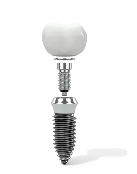 Dentiere e impianti su fondo bianco. Illustrazione 3D — Foto Stock