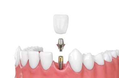 çene modeli diş implantı 3d çizim