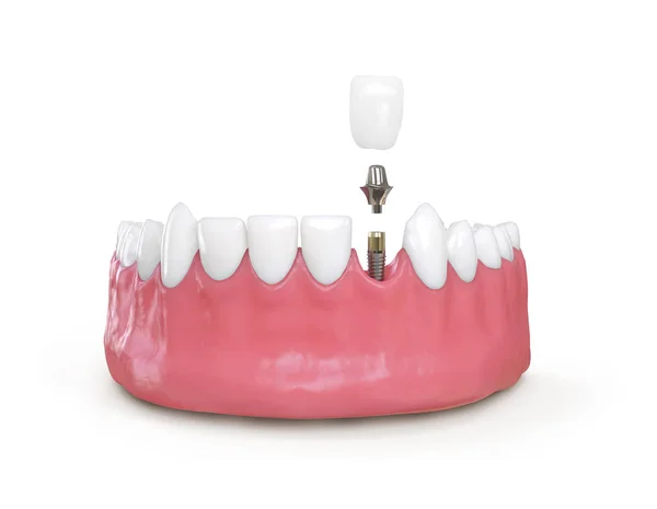 Dentes modelo de implante dentário ilustração 3d — Fotografia de Stock