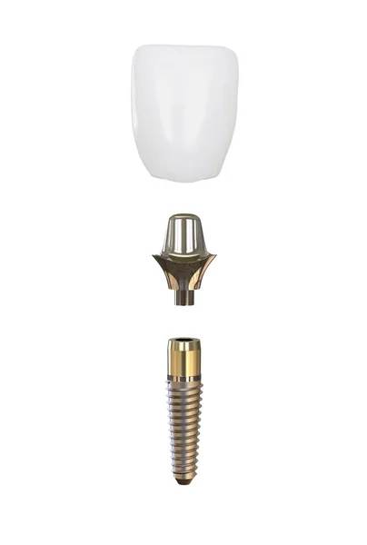 Implanty zębów modelu 3d ilustracja — Zdjęcie stockowe