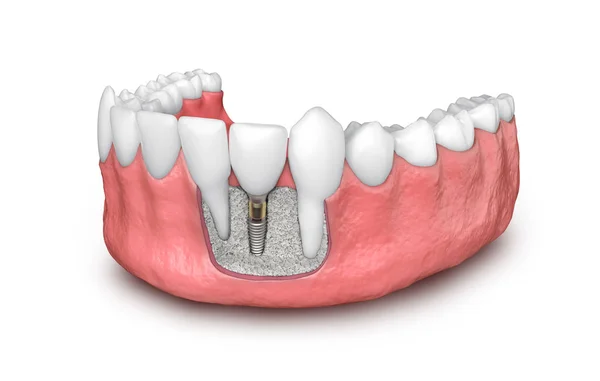 Dente modelo de implante dentário ilustração 3d — Fotografia de Stock