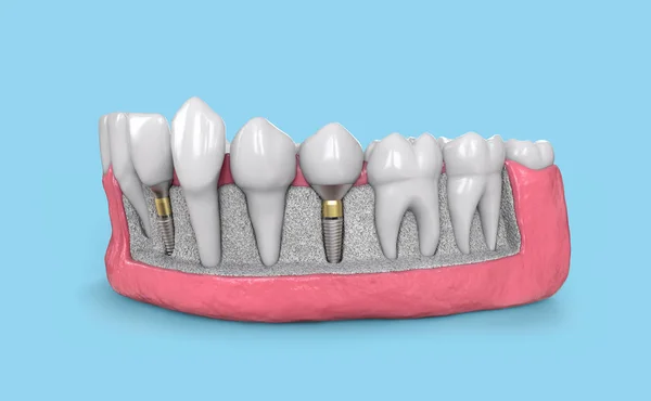 Modèle d'implant dentaire dans la mâchoire illustration 3d — Photo