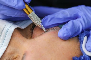 Microblasting eski makyaj kaldırmak.