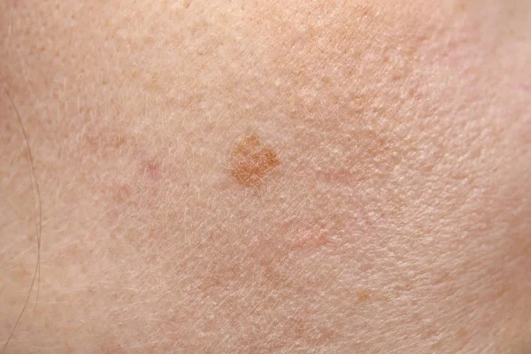 Pigmentation on the skin. — Stock Photo, Image