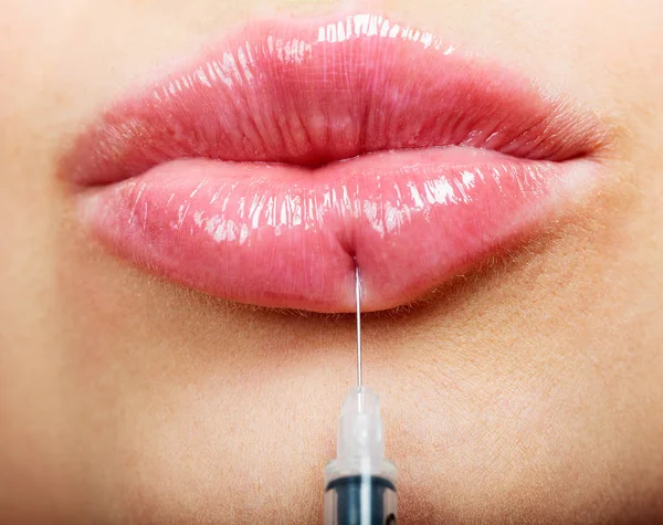Nahaufnahme schöner weiblicher Lippen und Spritze mit Füllstoff — Stockfoto