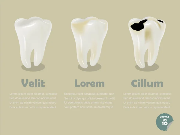 Conjunto de dientes realistas incluyendo dientes sanos y dientes deteriorados, gráficos de información de salud dental — Archivo Imágenes Vectoriales