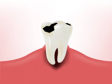 diş diş dişeti, diş sağlığı tasarım konsepti, yiyen bakteriler grafik tasarım çürüdü