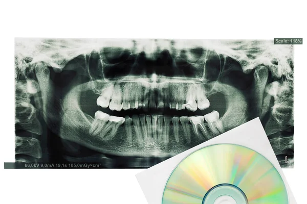 Raio-X foto impressa de dentes e disco digital . — Fotografia de Stock