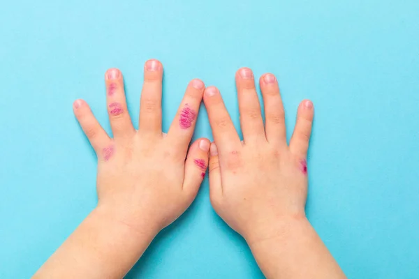 아이들의 손에 피부염 이 있습니다. 습진 이 나왔습니다. B 에 고립되다 — 스톡 사진