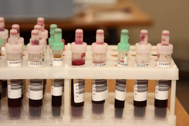 Doktorun muayenehanesindeki masada kan testleri yapılan ampuller.