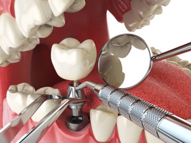İnsan implant diş. Diş implantasyon kavramı. İnsan dişleri veya