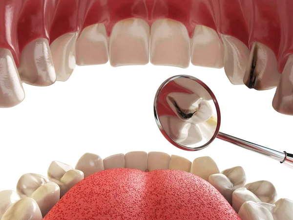 Человеческий зуб с кариесами и дырками и инструментами. Поиск зубов conc — стоковое фото