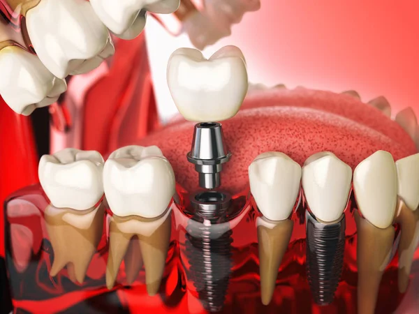 Tand implantat i modell människans tänder, tandkött och denturas. DenTa — Stockfoto