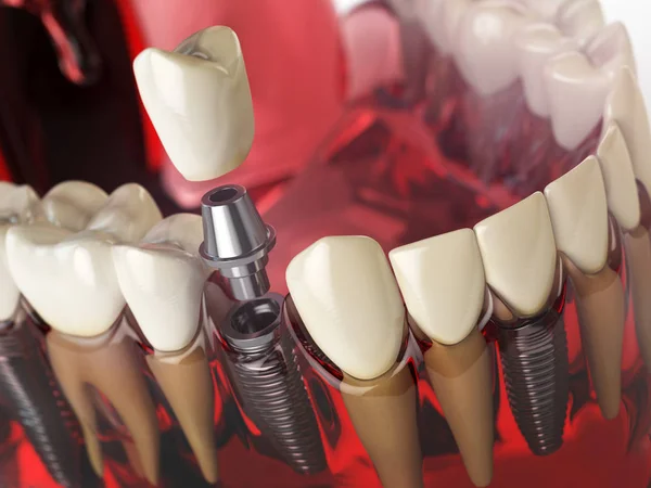 Implante dental en el modelo de dientes humanos, encías y denturas. Denta. — Foto de Stock