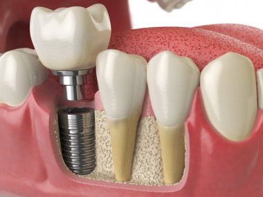 Sağlıklı dişler ve diş diş implant insan dentu anatomisi