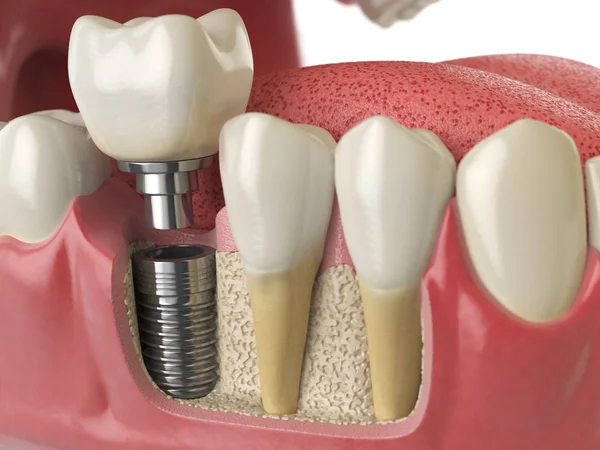 Ανατομία του υγιή δόντια και δόντι οδοντικό εμφύτευμα στην ανθρώπινη dentu — Φωτογραφία Αρχείου