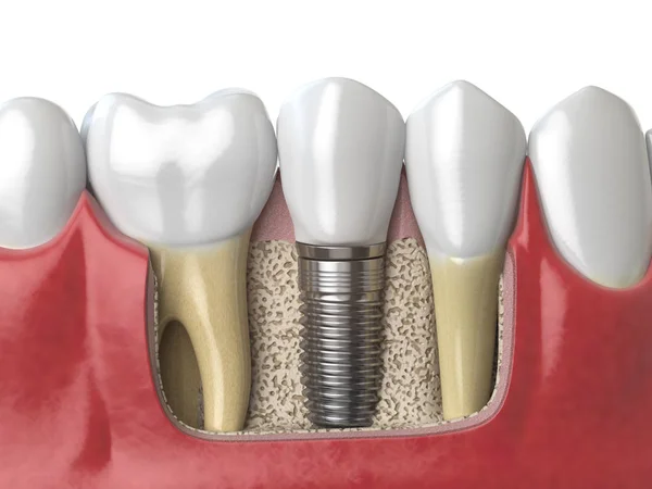 Anatomia de dentes saudáveis e implante dentário em dentina humana — Fotografia de Stock