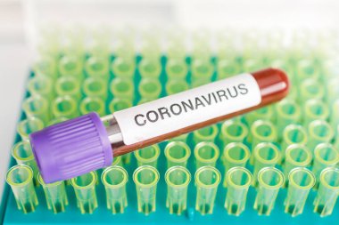 COVID-19 test tüpü ve yeni Corona virüsü enfeksiyonu (hastane geçmişinden gelen Corona virüsü hastalığı) tanısı için laboratuvar kan testi örneği. Bulaşıcı salgın konsepti