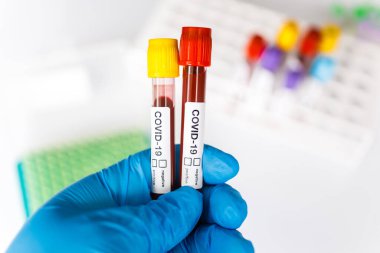 COVID-19 test tüpü ve yeni Corona virüsü enfeksiyonu (hastane geçmişinden gelen Corona virüsü hastalığı) tanısı için laboratuvar kan testi örneği. Bulaşıcı salgın konsepti