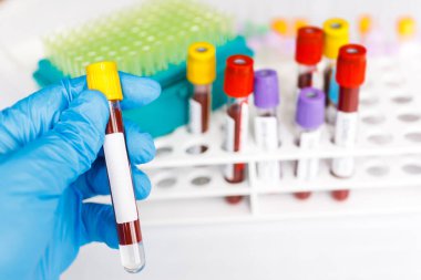 COVID-19 test tüpü ve yeni Corona virüsü enfeksiyonu (hastane geçmişinden gelen Corona virüsü hastalığı) tanısı için laboratuvar kan testi örneği. Bulaşıcı salgın konsepti