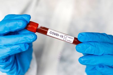 COVID-19 test tüpü ve yeni Corona virüsü enfeksiyonu (hastane geçmişinden gelen Corona virüsü hastalığı) tanısı için laboratuvar kan testi örneği. Bulaşıcı salgın konsepti