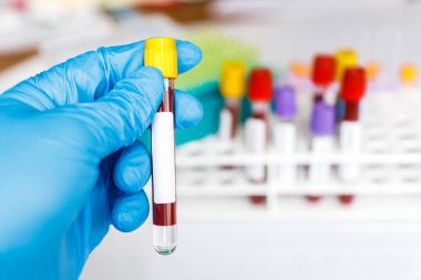 COVID-19 test tüpü ve yeni Corona virüsü enfeksiyonu (hastane geçmişinden gelen Corona virüsü hastalığı) tanısı için laboratuvar kan testi örneği. Bulaşıcı salgın konsepti