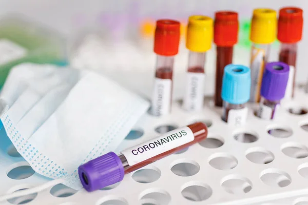 Covid Test Tube Laboratory Sample Blood Testing Diagnosis New Corona — Stock Photo, Image