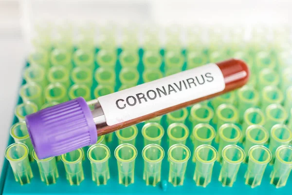 Covid 19検査管と血液検査室のサンプルを用いて 新しいコロナウイルス感染症 病院の背景から新しいコロナウイルス病 を診断します 感染症の概念 — ストック写真