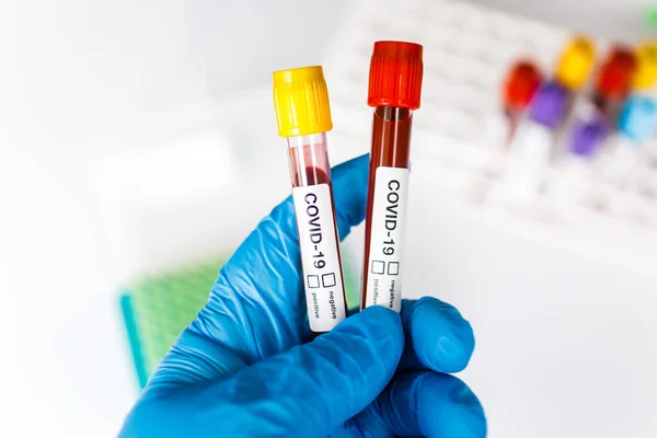 Covid Test Tube Laboratory Sample Blood Testing Diagnosis New Corona — Stock Photo, Image