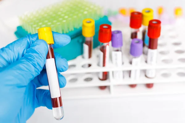 Covid Test Tube Laboratory Sample Blood Testing Diagnosis New Corona — Stock Photo, Image