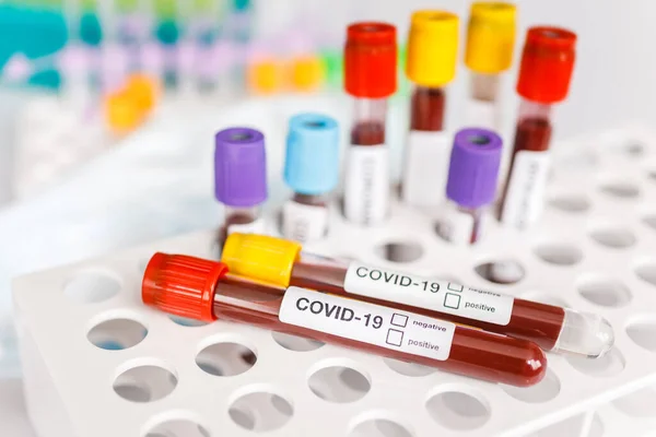 Tubo Teste Covid Amostra Laboratório Exames Sangue Para Diagnóstico Nova Fotos De Bancos De Imagens