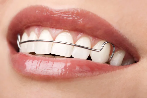 Женщина Красивые Зубы Фиксатором Ортодонтической Коррекции — стоковое фото