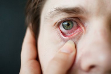 Mens red eye close-up, fatigue, problems with blood vessels clipart