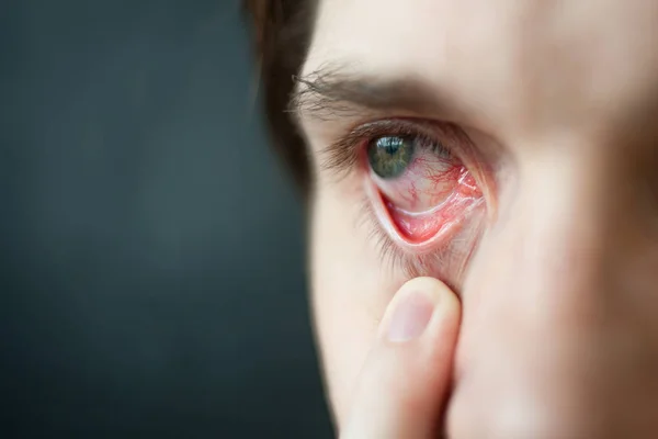 Mens red eye close-up, fatigue, problems with blood vessels — Stock Photo, Image