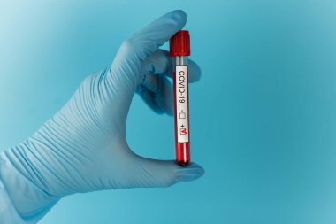 Doktorun elinde çok az kan tüpü var. Cov Coronavirus hastanede pozitif çıktı. Yeni hızla yayılan Coronavirüs, dünya salgını.