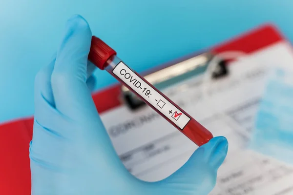 血液検査の結果 医師の手のチューブは 病院で陽性ラベルを検査します 世界的なパンデミックであるコロナウイルスが急速に拡大し — ストック写真