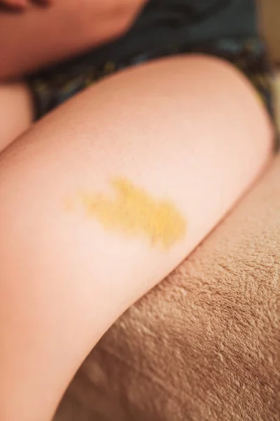 Large Bruise Yellow Hematoma Thigh Severe Bruise — Stock Photo, Image