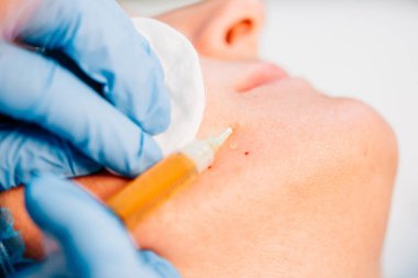 Plazma kaldırma - estetik kozmetoloji ve gençleştirme