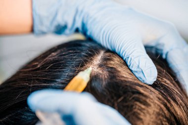 Lastik eldivenli doktor tıbbi bir prosedür uygular. Hastanın kafa derisine bir iğne yapar. Saç onarımı.